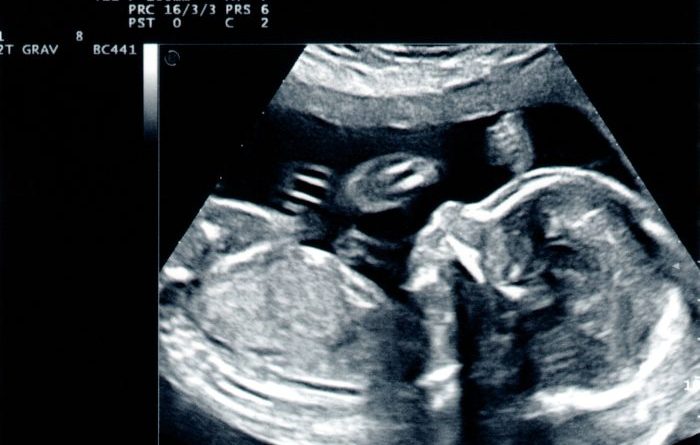 Ovarian Cyst During Pregnancy - Understanding the Condition